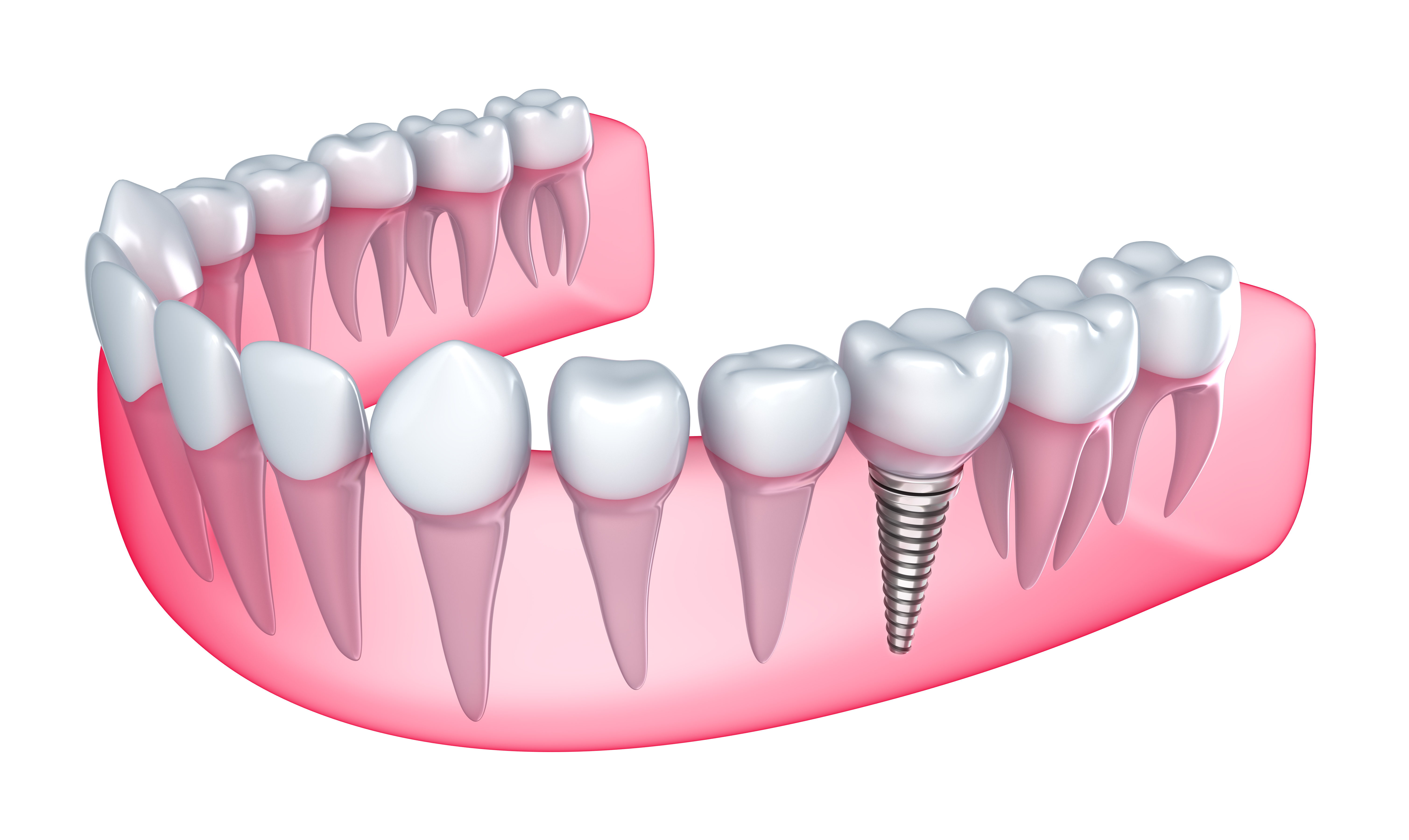 Dental Implants in Ahmedabad
